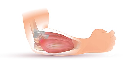 tennis-elbow-pain