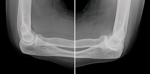 ElbowOsteoarthritis x-ray elbow pain