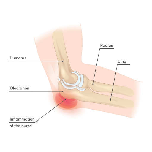 Elbow_-_Inflammation_of_the_bursa elbow pain