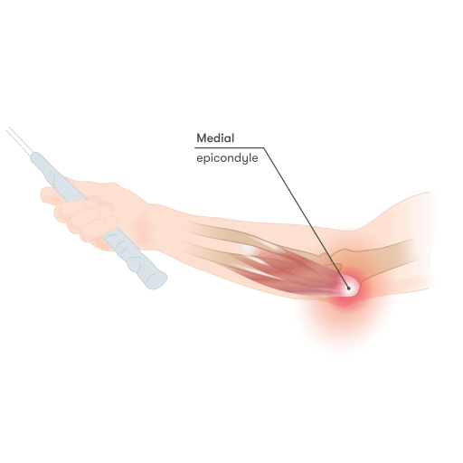 Medial_epicondylitis.golfers elbow pain