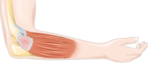 Tendon_inflammation_-_Tendonitis_elbow pain